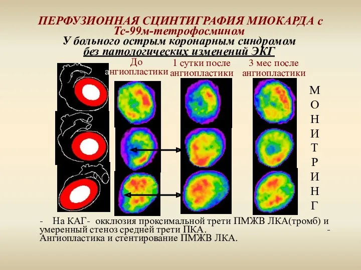 ПЕРФУЗИОННАЯ СЦИНТИГРАФИЯ МИОКАРДА с Тс-99м-тетрофосмином У больного острым коронарным синдромом