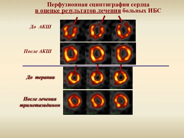 Перфузионная сцинтиграфия сердца в оценке результатов лечения больных ИБС До