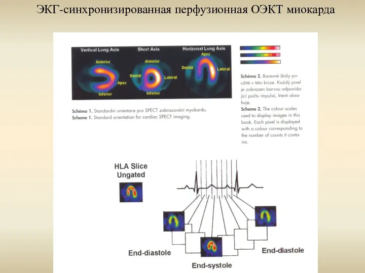 ЭКГ-синхронизированная перфузионная ОЭКТ миокарда