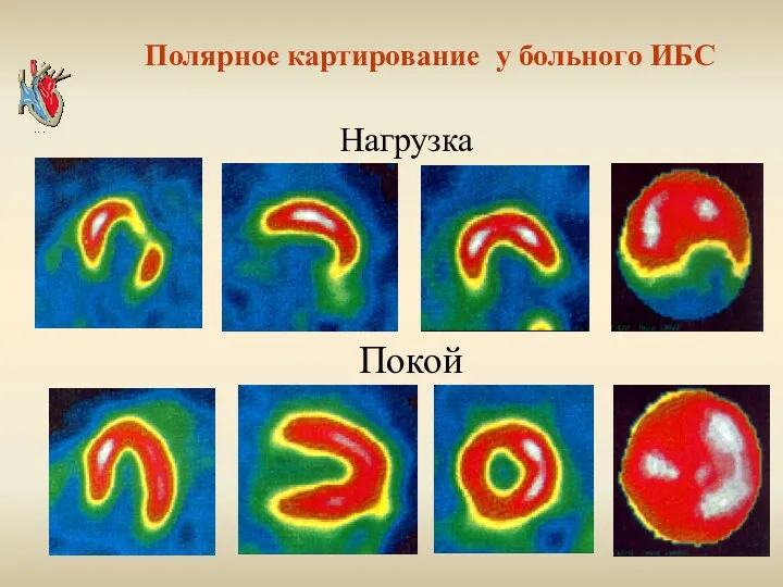 Полярное картирование у больного ИБС Покой Нагрузка