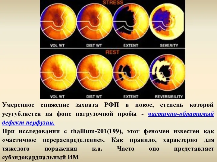 Умеренное снижение захвата РФП в покое, степень которой усугубляется на