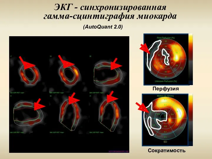 ЭКГ - синхронизированная гамма-сцинтиграфия миокарда Перфузия Сократимость (AutoQuant 2.0)