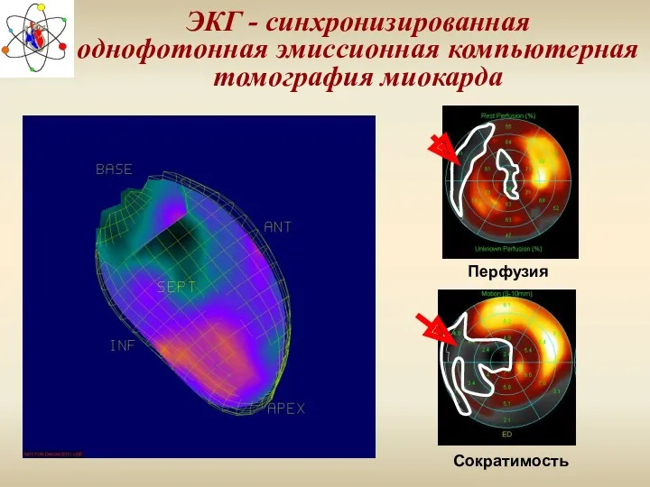 ЭКГ - синхронизированная однофотонная эмиссионная компьютерная томография миокарда Перфузия Сократимость