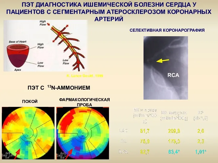 ПЭТ ДИАГНОСТИКА ИШЕМИЧЕСКОЙ БОЛЕЗНИ СЕРДЦА У ПАЦИЕНТОВ С СЕГМЕНТАРНЫМ АТЕРОСКЛЕРОЗОМ