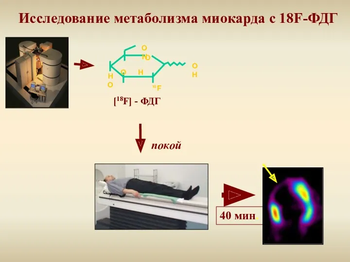 Исследование метаболизма миокарда с 18F-ФДГ 40 мин. покой