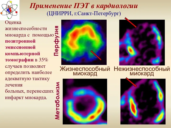 Применение ПЭТ в кардиологии (ЦНИРРИ, г.Санкт-Петербург) Перфузия Метаболизм Жизнеспособный миокард