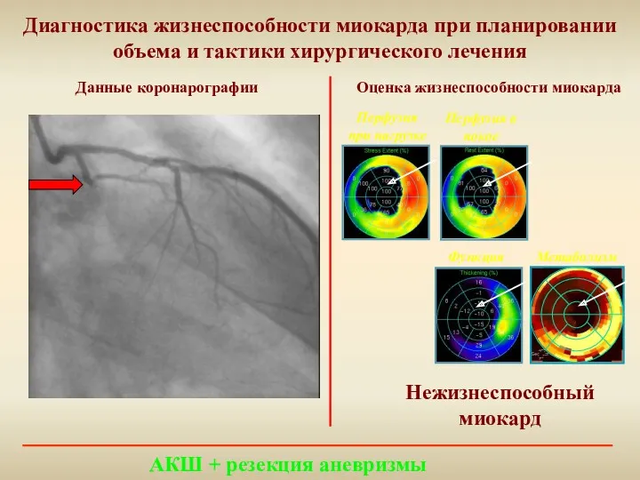 Диагностика жизнеспособности миокарда при планировании объема и тактики хирургического лечения АКШ + резекция аневризмы