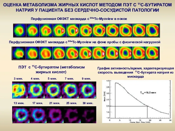 T1/2 =18,5 мин ПЭТ с 11С-бутиратом (метаболизм жирных кислот) 3