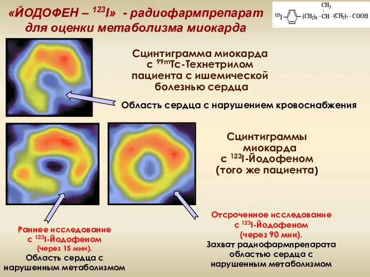 «ЙОДОФЕН – 123I» - радиофармпрепарат для оценки метаболизма миокарда Сцинтиграмма