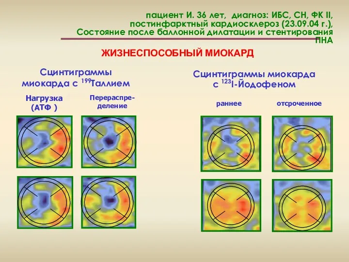 пациент И. 36 лет, диагноз: ИБС, СН, ФК II, постинфарктный