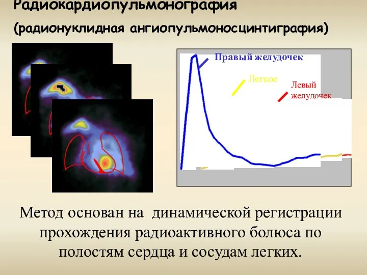 Радиокардиопульмонография (радионуклидная ангиопульмоносцинтиграфия) Метод основан на динамической регистрации прохождения радиоактивного