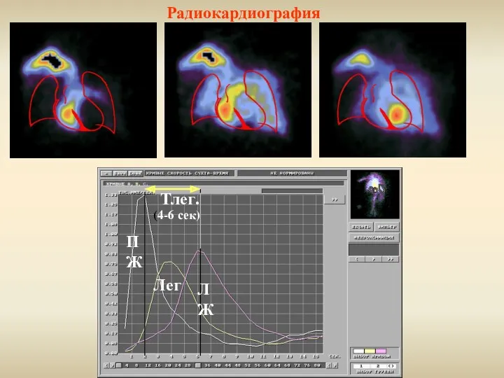 Радиокардиография Тлег. ПЖ Лег ЛЖ (4-6 сек)