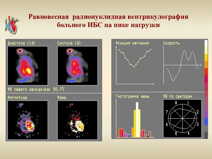 Равновесная радионуклидная вентрикулография больного ИБС на пике нагрузки