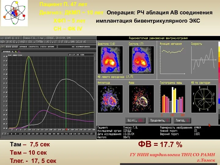 Пациент П. 47 лет Диагноз: ДКМП ~ 10 лет Операция: