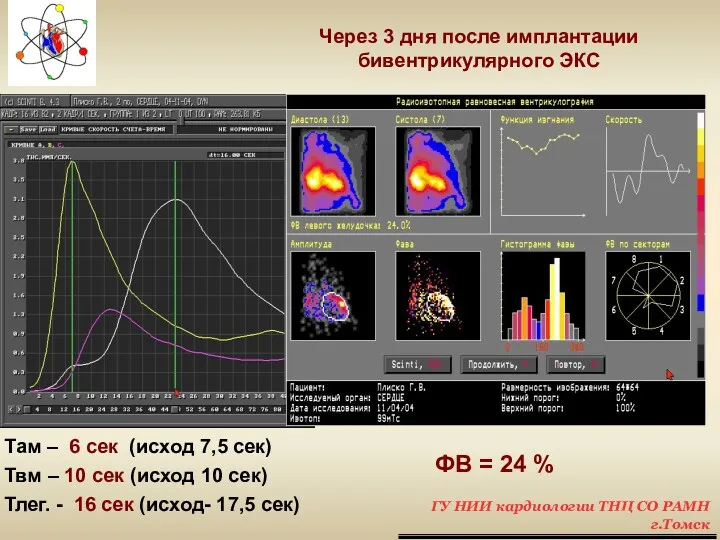 ФВ = 24 % Через 3 дня после имплантации бивентрикулярного