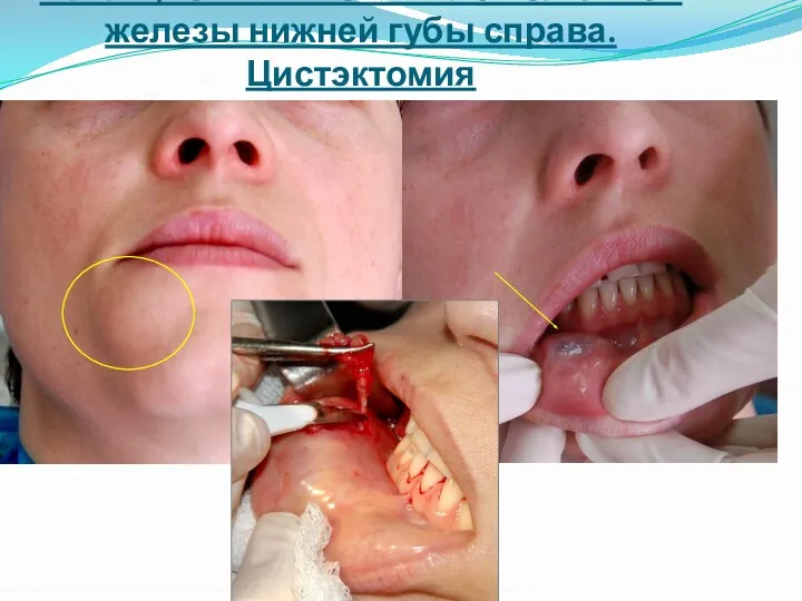 Ретенционная киста малой слюнной железы нижней губы справа. Цистэктомия