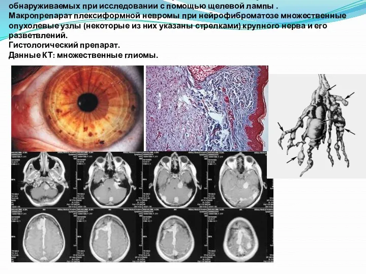 Глиома зрительного нерва; два и более узелков Лиша на радужной оболочке, обнаруживаемых при