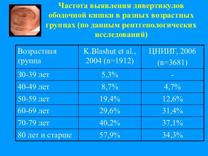 Частота выявления дивертикулов ободочной кишки в разных возрастных группах (по данным рентгенологических исследований)