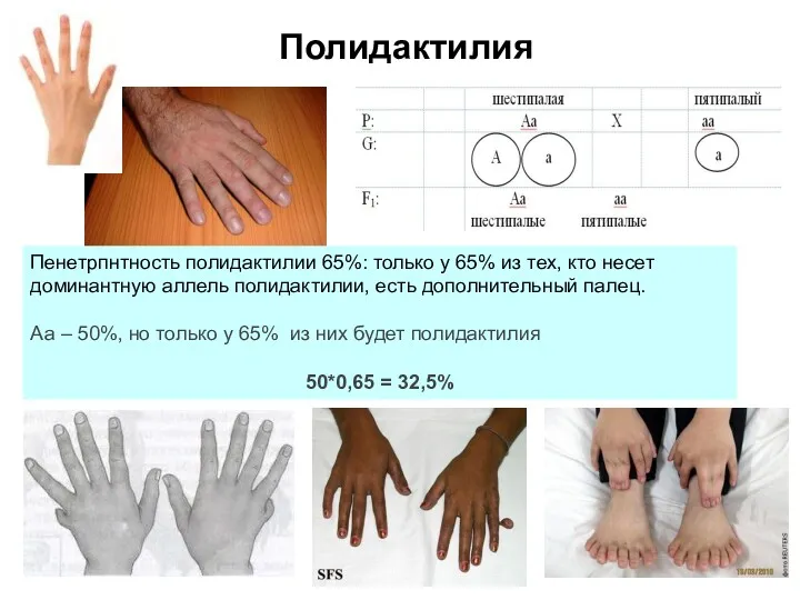 Полидактилия Пенетрпнтность полидактилии 65%: только у 65% из тех, кто