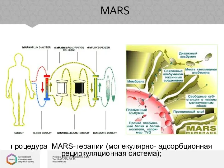 MARS Молекулярная Адсорбирующая Рециркулирующая Система процедура MARS-терапии (молекулярно- адсорбционная рециркуляционная система);