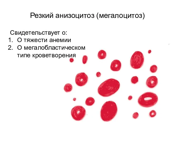 Резкий анизоцитоз (мегалоцитоз) Свидетельствует о: О тяжести анемии О мегалобластическом типе кроветворения