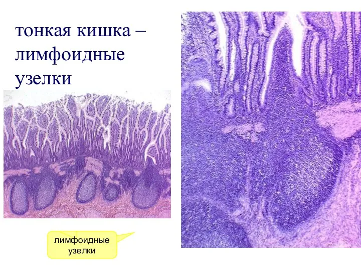 тонкая кишка – лимфоидные узелки лимфоидные узелки