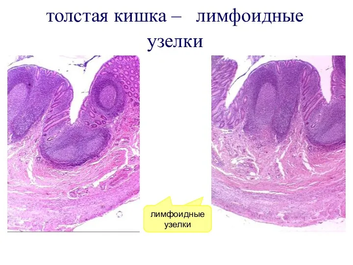 толстая кишка – лимфоидные узелки лимфоидные узелки лимфоидные узелки