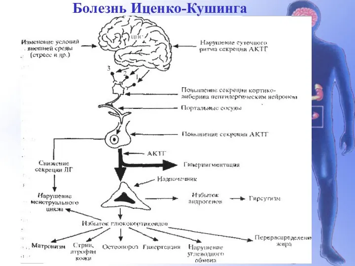 Болезнь Иценко-Кушинга