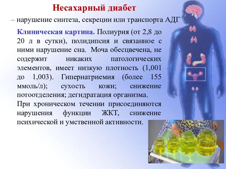 Клиническая картина. Полиурия (от 2,8 до 20 л в сутки),