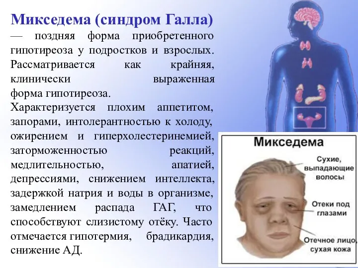 Микседема (синдром Галла) — поздняя форма приобретенного гипотиреоза у подростков