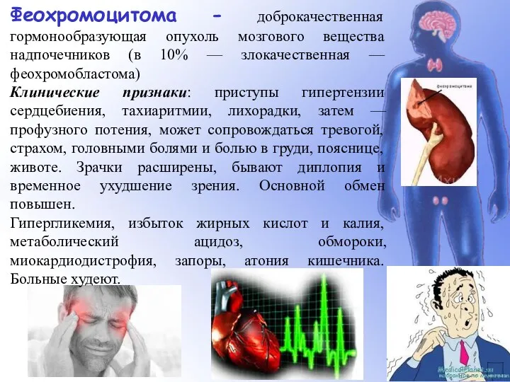 Феохромоцитома - доброкачественная гормонообразующая опухоль мозгового вещества надпочечников (в 10%