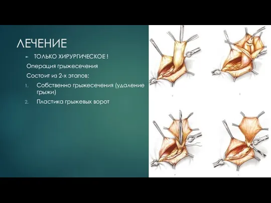 ЛЕЧЕНИЕ ТОЛЬКО ХИРУРГИЧЕСКОЕ ! Операция грыжесечения Состоит из 2-х этапов: