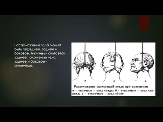 Расположение узла может быть переднее, заднее и боковое. Типичным считается