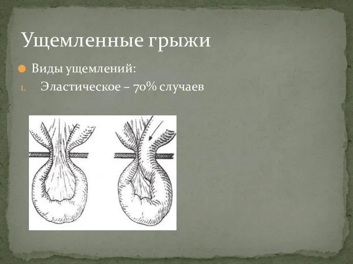 Виды ущемлений: Эластическое – 70% случаев Ущемленные грыжи