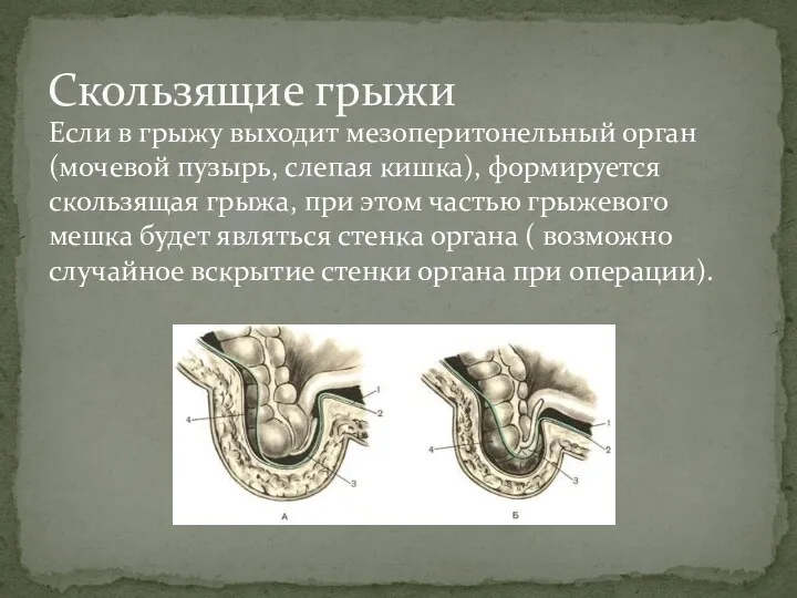 Если в грыжу выходит мезоперитонельный орган (мочевой пузырь, слепая кишка),