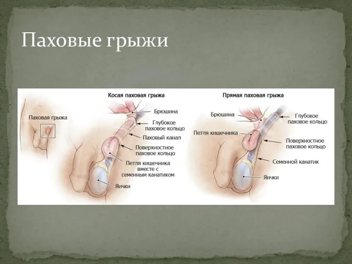 Паховые грыжи