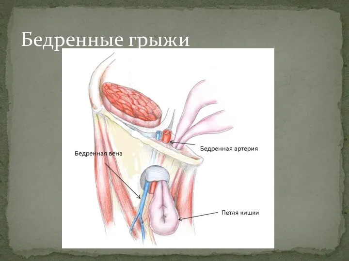 Бедренные грыжи