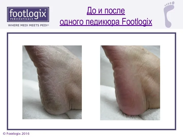 До и после одного педикюра Footlogix