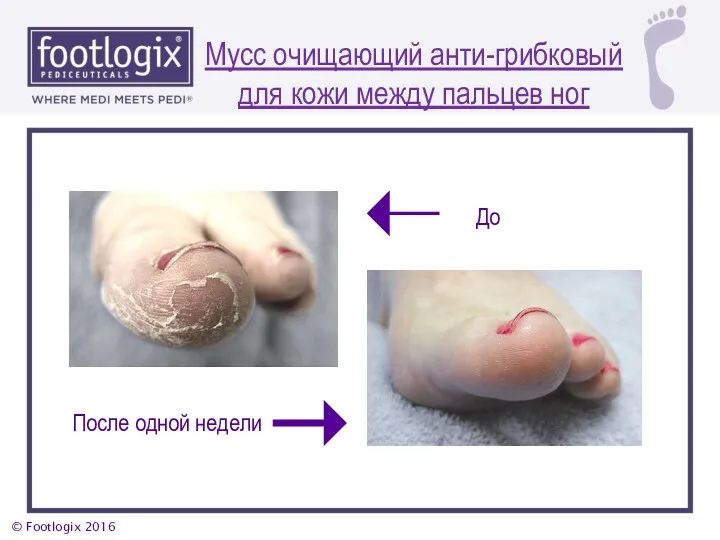 Мусс очищающий анти-грибковый для кожи между пальцев ног После одной недели До