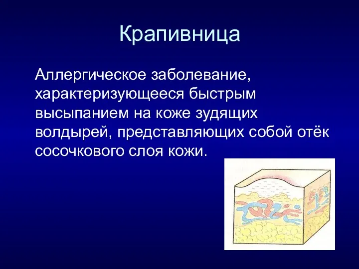 Крапивница Аллергическое заболевание, характеризующееся быстрым высыпанием на коже зудящих волдырей, представляющих собой отёк сосочкового слоя кожи.