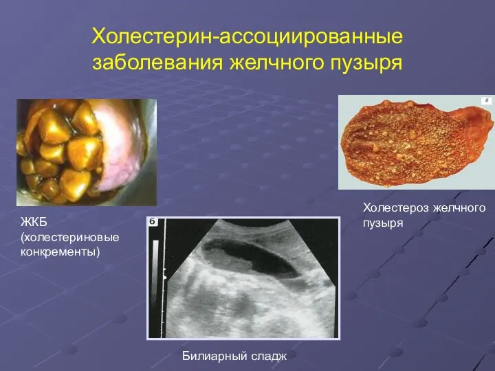 Холестерин-ассоциированные заболевания желчного пузыря ЖКБ (холестериновые конкременты) Холестероз желчного пузыря Билиарный сладж