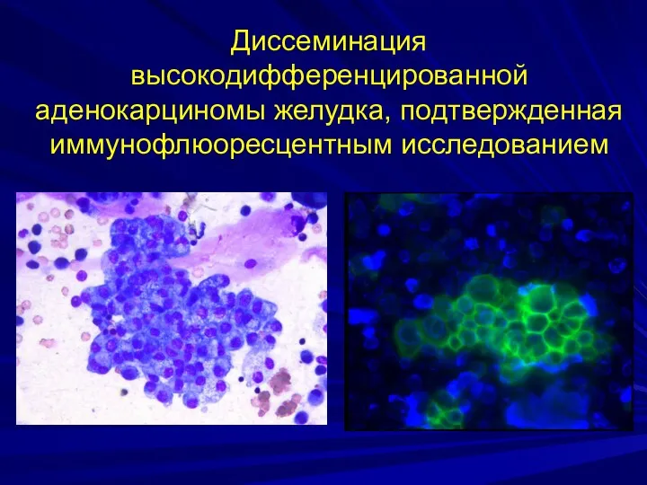 Диссеминация высокодифференцированной аденокарциномы желудка, подтвержденная иммунофлюоресцентным исследованием