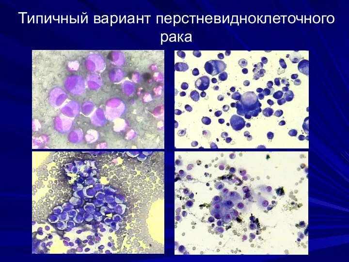 Типичный вариант перстневидноклеточного рака