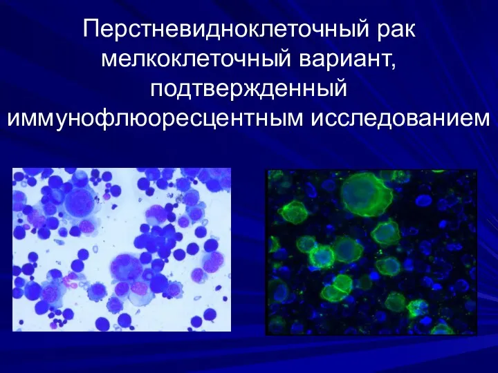 Перстневидноклеточный рак мелкоклеточный вариант, подтвержденный иммунофлюоресцентным исследованием