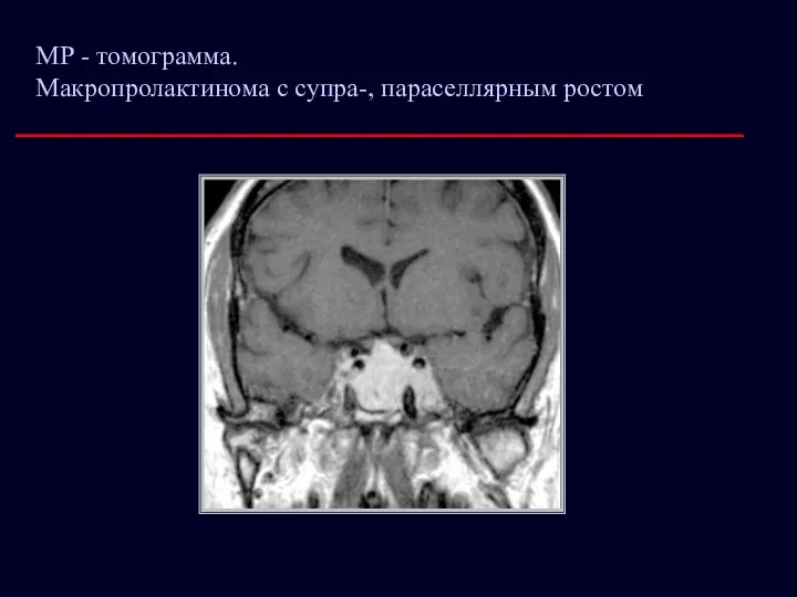 МР - томограмма. Макропролактинома с супра-, параселлярным ростом
