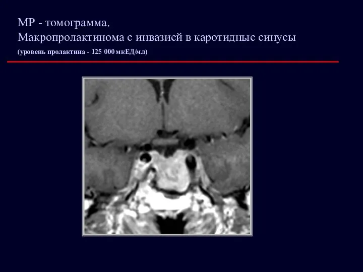 МР - томограмма. Макропролактинома с инвазией в каротидные синусы (уровень пролактина - 125 000 мкЕД/мл)