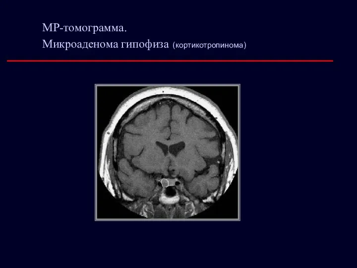 МР-томограмма. Микроаденома гипофиза (кортикотропинома)