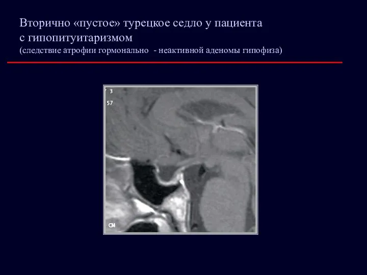 Вторично «пустое» турецкое седло у пациента с гипопитуитаризмом (следствие атрофии гормонально - неактивной аденомы гипофиза)