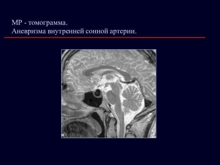 МР - томограмма. Аневризма внутренней сонной артерии.