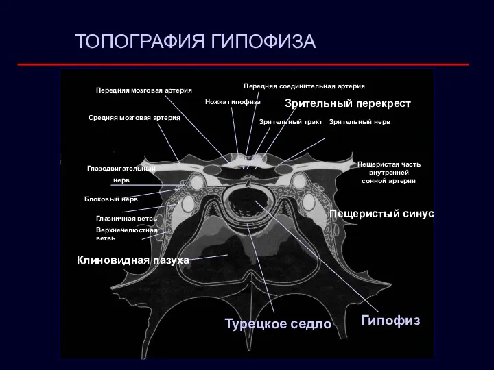 Ножка гипофиза Передняя соединительная артерия Зрительный тракт Зрительный перекрест Пещеристая